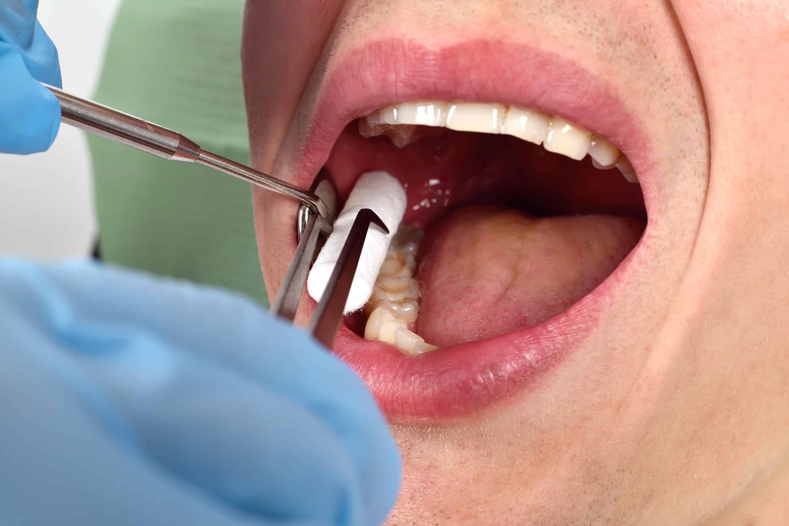 Comment le dentiste soigne une carie - crédits 123rf.com