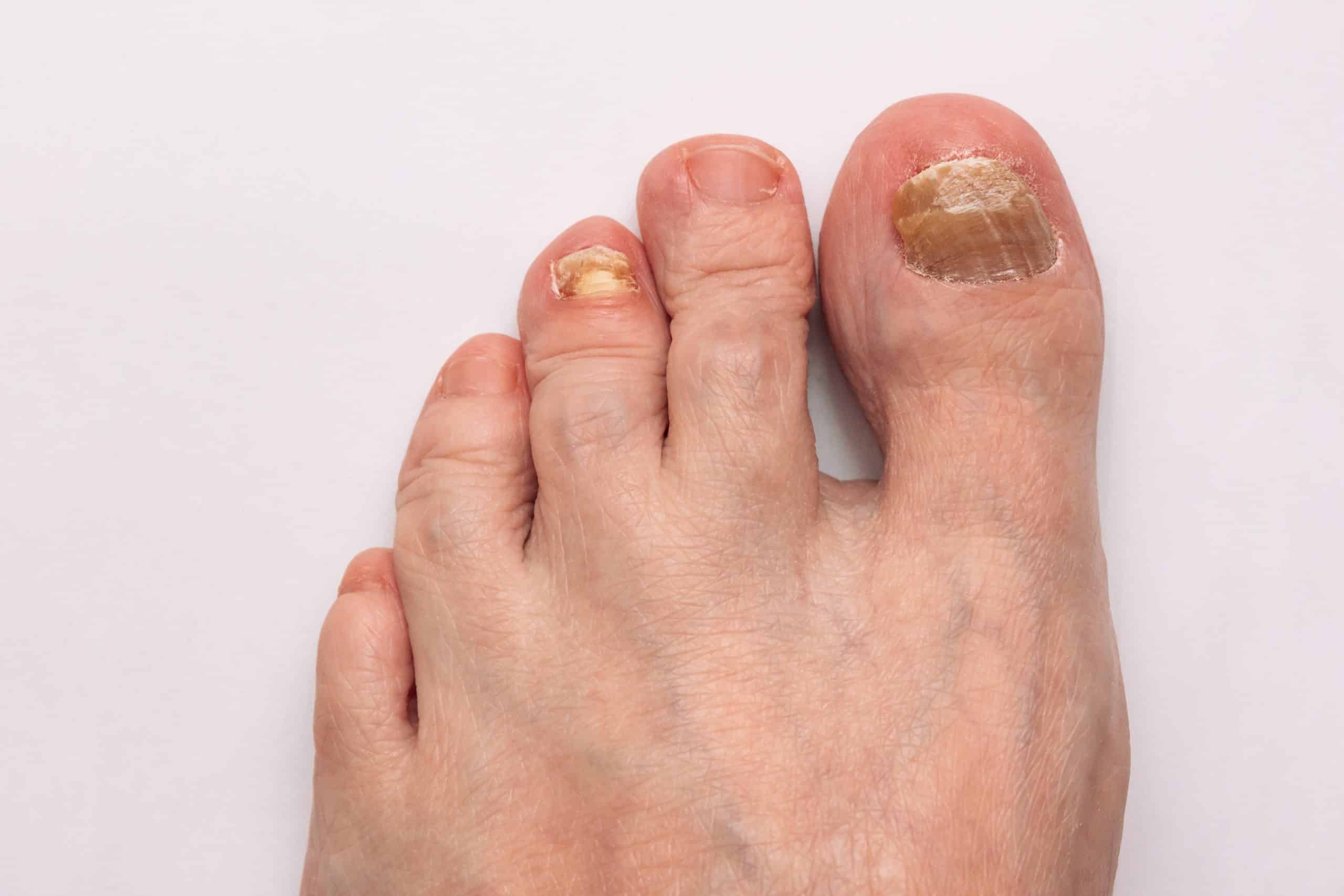 Mycose ongle pied