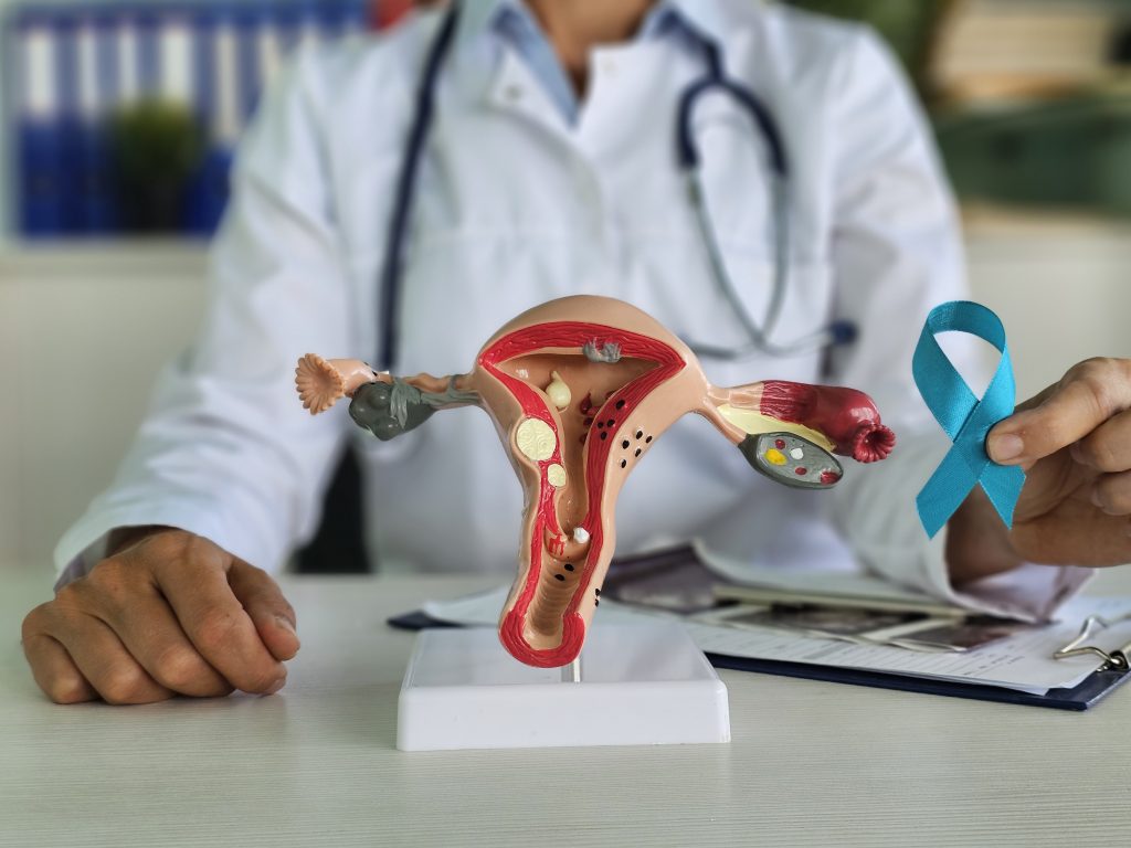 Cancer des Ovaires - Cancer des Ovaires - Cancer des Ovaires