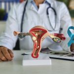 Cancer des Ovaires - Cancer des Ovaires - Cancer des Ovaires