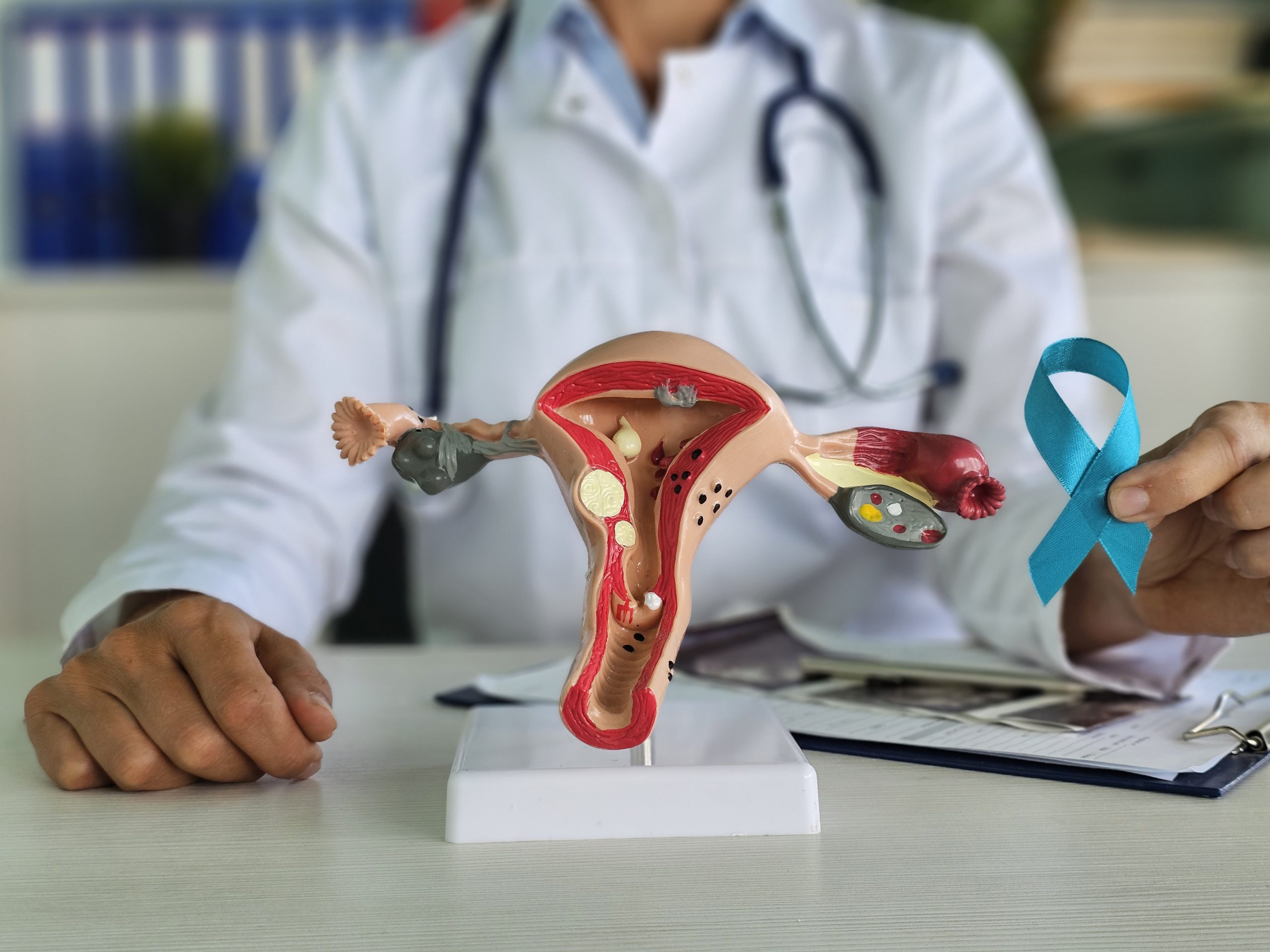 Cancer des Ovaires - Cancer des Ovaires - Cancer des Ovaires