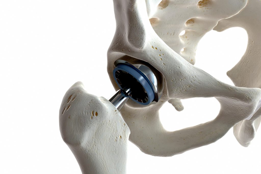 Prothèse de Hanche Nouvelle Génération  - Prothèse de Hanche Nouvelle Génération - Prothèse de Hanche Nouvelle Génération