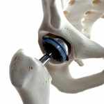 Prothèse de Hanche Nouvelle Génération - Prothèse de Hanche Nouvelle Génération - Prothèse de Hanche Nouvelle Génération