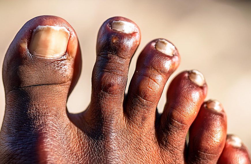 Ongle du pied qui noircit :…